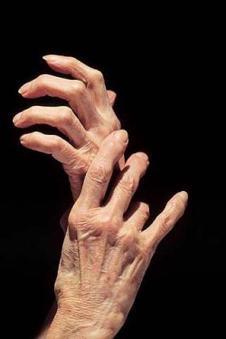 glucosamine and joint pain