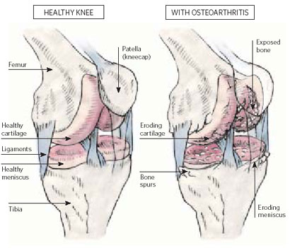 joint pain glucosamine